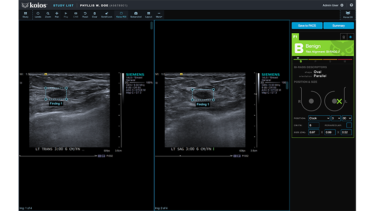PACS view of Koios DS Breast software